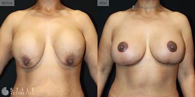 Breast Augmentation with Lift Before & After Gallery - Patient 394706 - Image 1