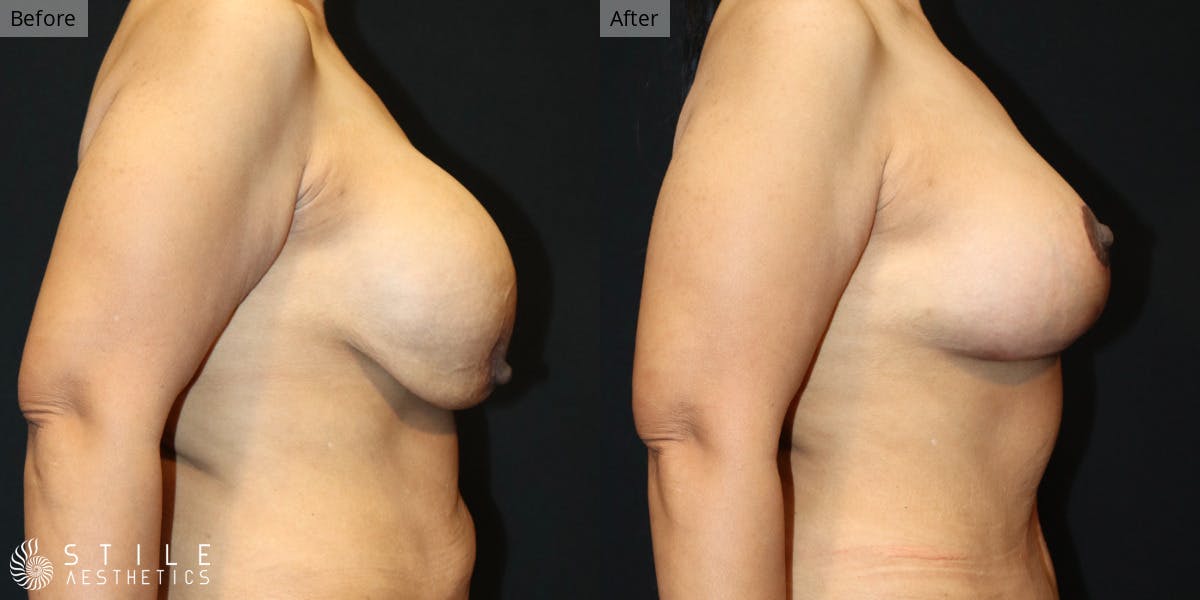 Breast Augmentation with Lift Before & After Gallery - Patient 394706 - Image 2