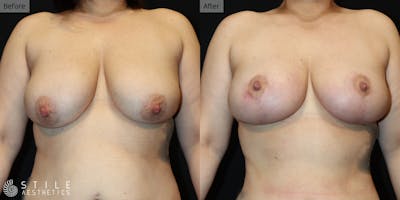 Breast Lift Before & After Gallery - Patient 219196 - Image 1