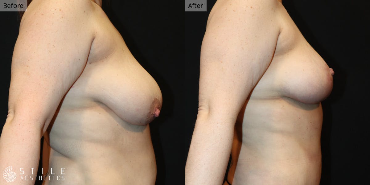 Breast Lift Before & After Gallery - Patient 219196 - Image 2