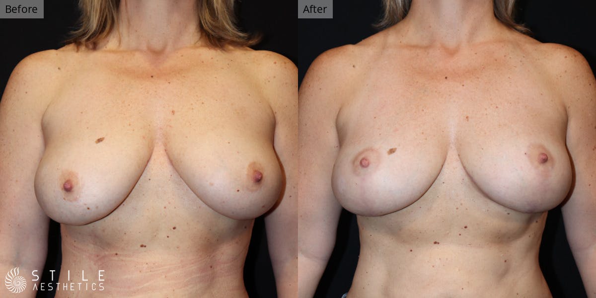 Breast Lift Before & After Gallery - Patient 233714 - Image 1