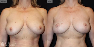 Breast Lift Before & After Gallery - Patient 233714 - Image 1