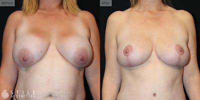 Breast Lift Before & After Gallery - Patient 252564 - Image 1
