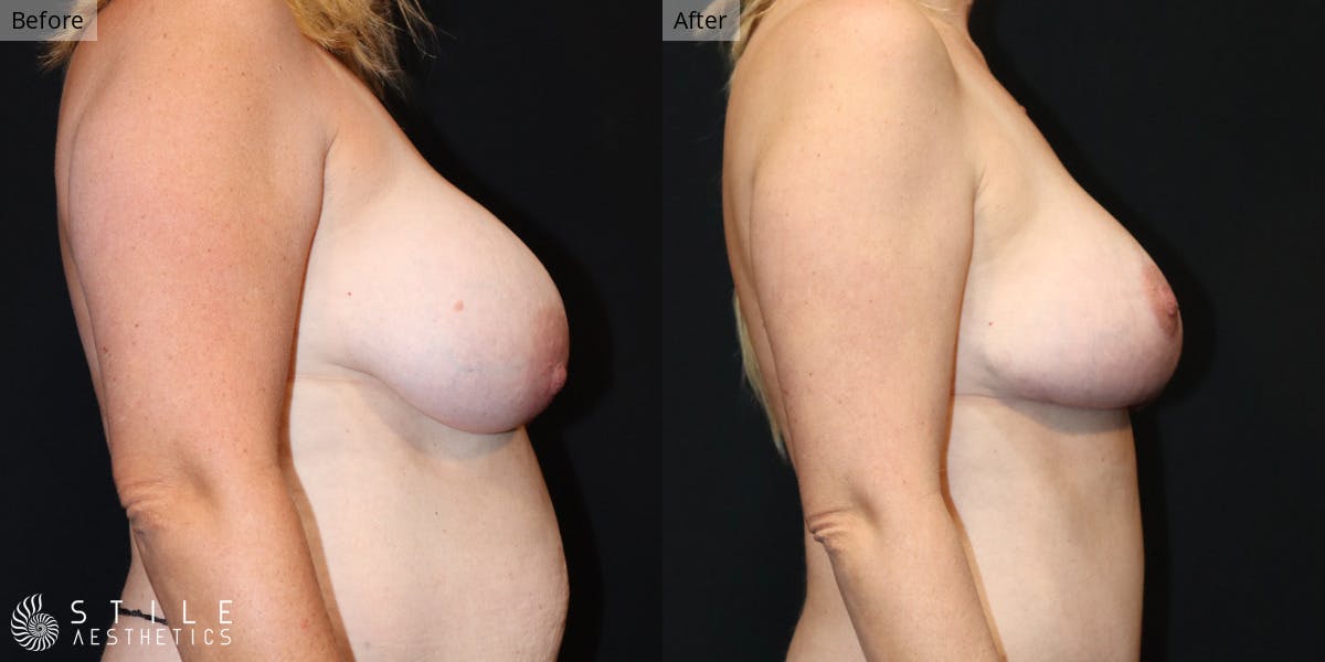 Breast Lift Before & After Gallery - Patient 252564 - Image 2
