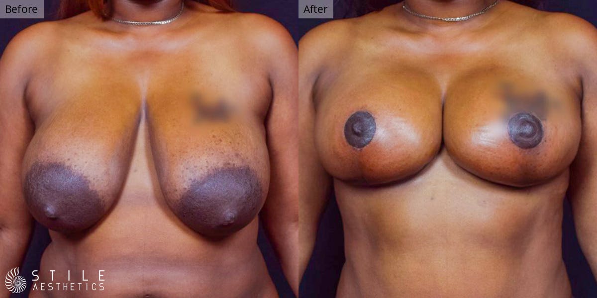 Breast Lift Before & After Gallery - Patient 848556 - Image 1