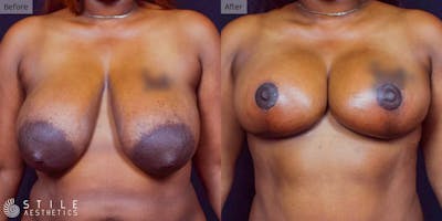 Breast Lift Before & After Gallery - Patient 848556 - Image 1