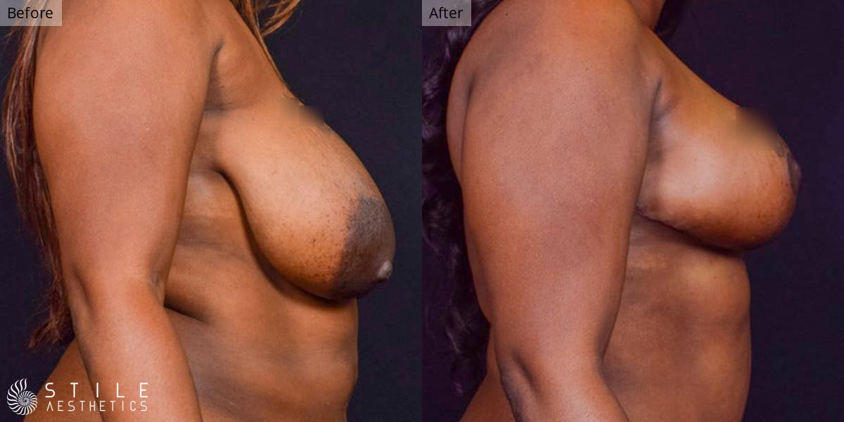 Breast Lift Before & After Gallery - Patient 848556 - Image 2