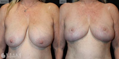 Breast Lift Before & After Gallery - Patient 272544 - Image 1