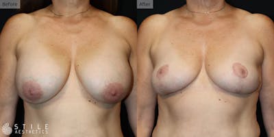 Breast Lift Before & After Gallery - Patient 497767 - Image 1