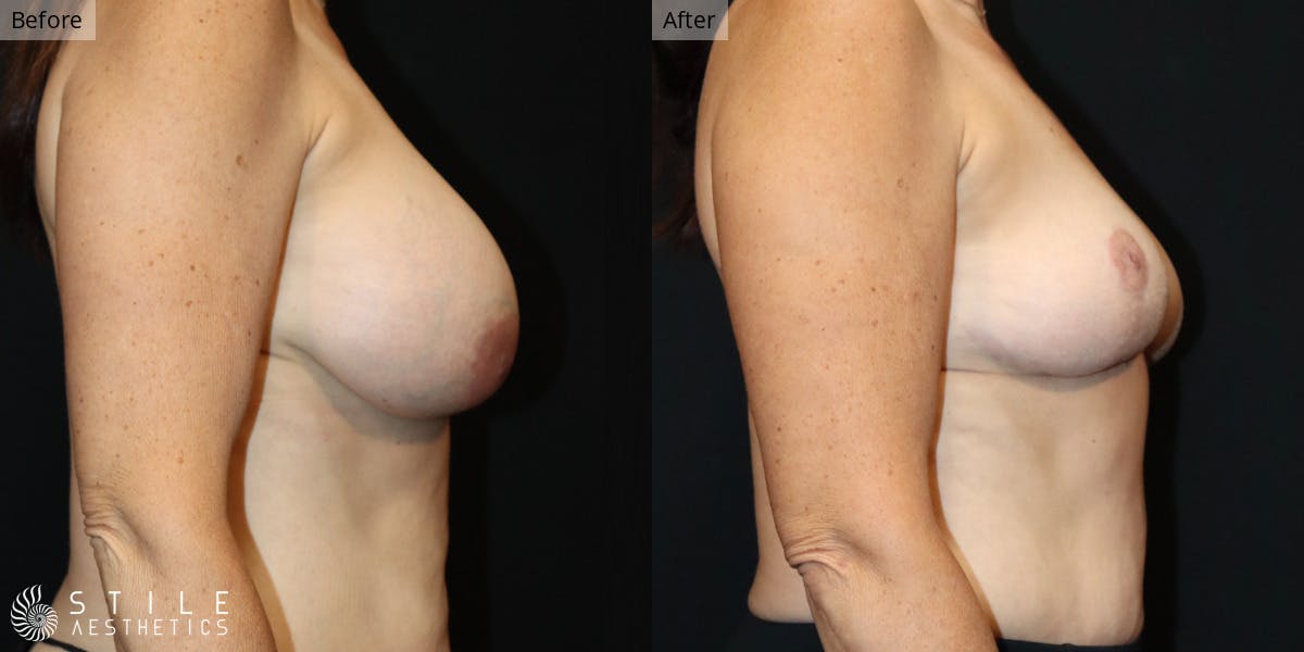 Breast Lift Before & After Gallery - Patient 497767 - Image 2