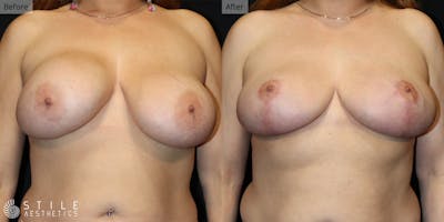 Breast Lift Before & After Gallery - Patient 386972 - Image 1