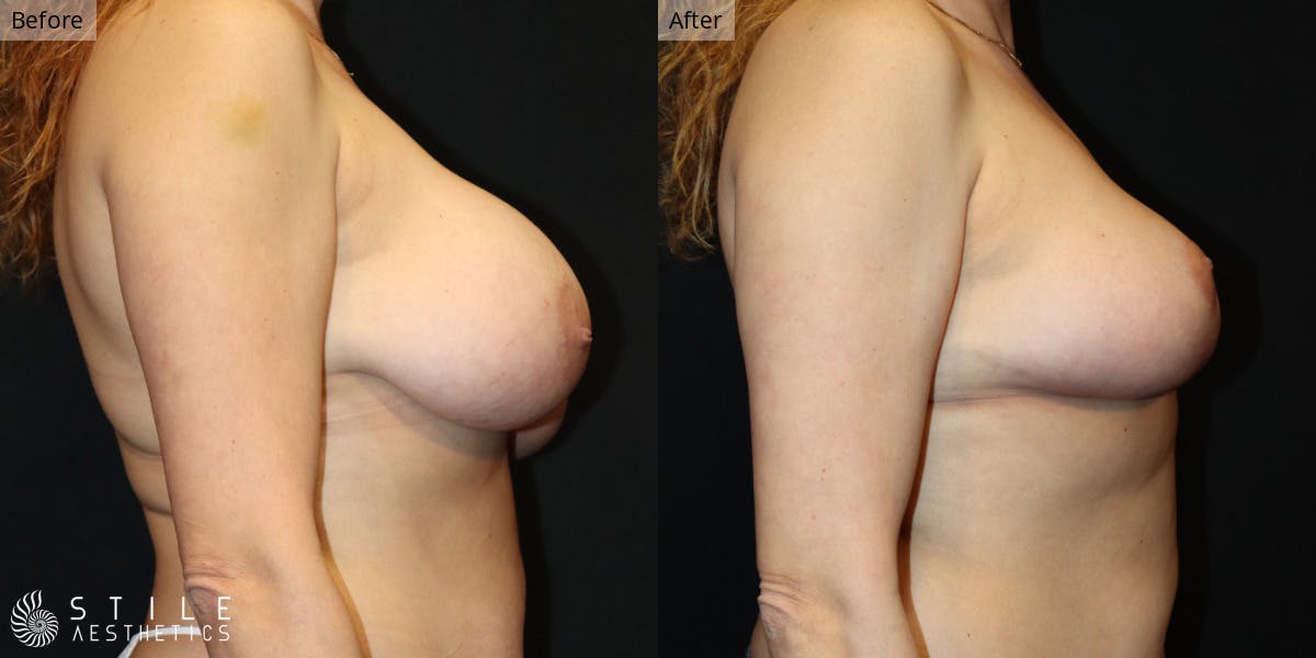 Breast Lift Before & After Gallery - Patient 386972 - Image 2