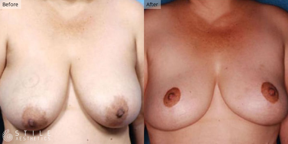 Breast Reduction Before & After Gallery - Patient 706302 - Image 1