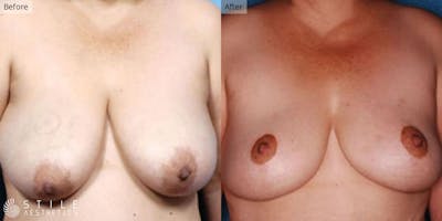 Breast Reduction Before & After Gallery - Patient 706302 - Image 1