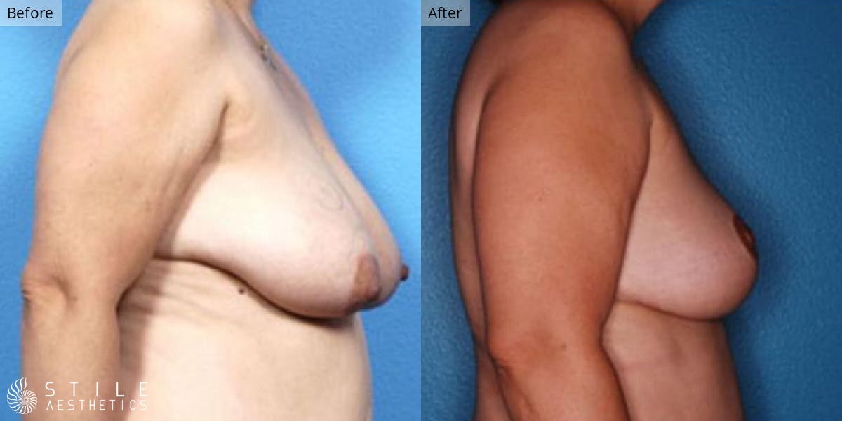 Breast Reduction Before & After Gallery - Patient 706302 - Image 2