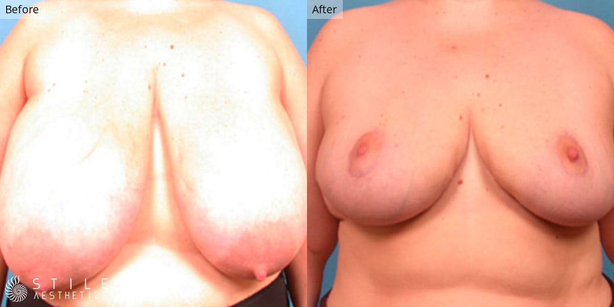 Breast Reduction Before & After Gallery - Patient 865032 - Image 1