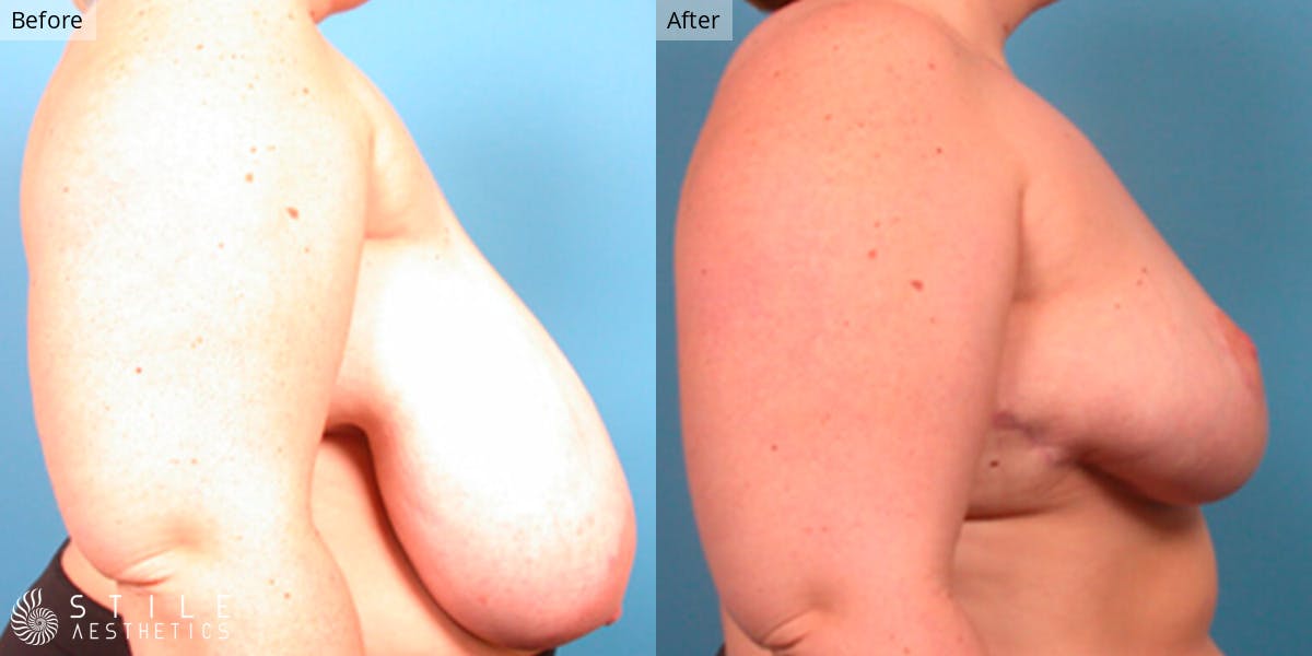 Breast Reduction Before & After Gallery - Patient 865032 - Image 2