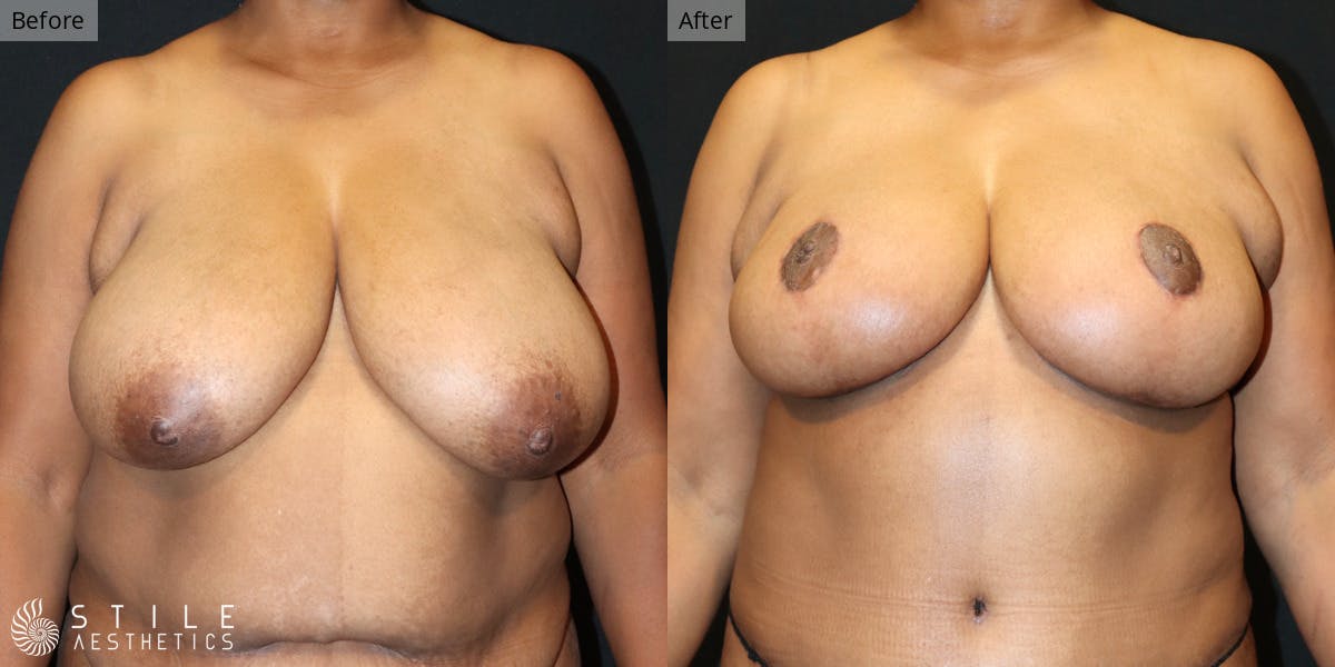 Breast Reduction Before & After Gallery - Patient 148068 - Image 1