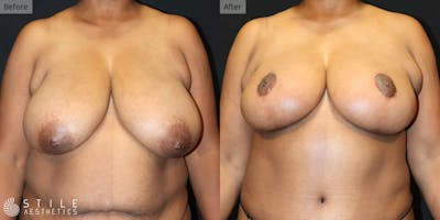 Breast Reduction Before & After Gallery - Patient 148068 - Image 1