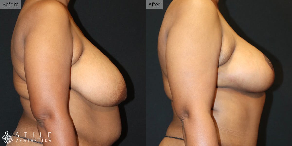 Breast Reduction Before & After Gallery - Patient 148068 - Image 2