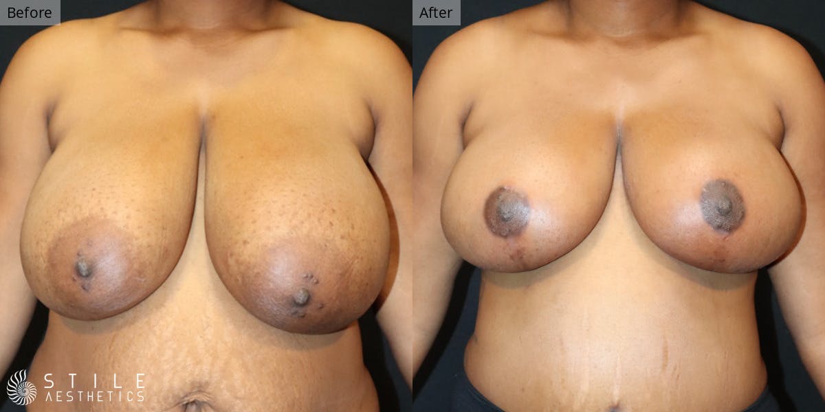 Breast Reduction Before & After Gallery - Patient 124535 - Image 1