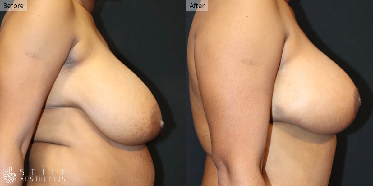Breast Reduction Before & After Gallery - Patient 124535 - Image 2