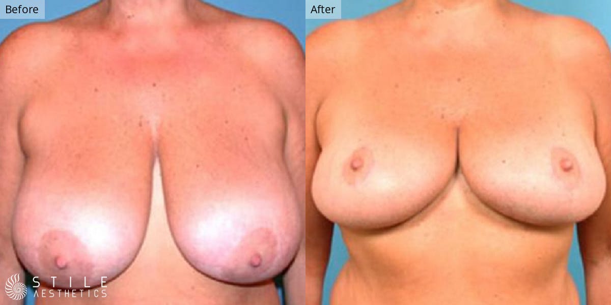 Breast Reduction Before & After Gallery - Patient 329973 - Image 1
