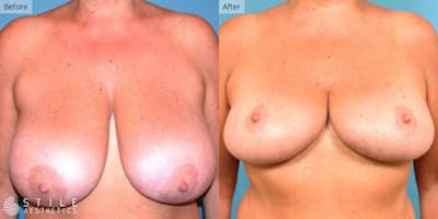 Breast Reduction Before & After Gallery - Patient 329973 - Image 1