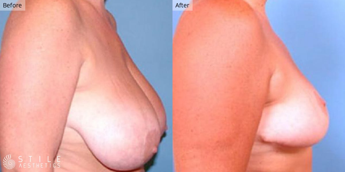 Breast Reduction Before & After Gallery - Patient 329973 - Image 2