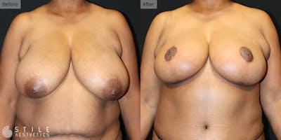Breast Reduction Before & After Gallery - Patient 192381 - Image 1