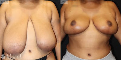 Breast Reduction Before & After Gallery - Patient 411766 - Image 1