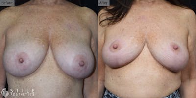Breast Reduction Before & After Gallery - Patient 424994 - Image 1
