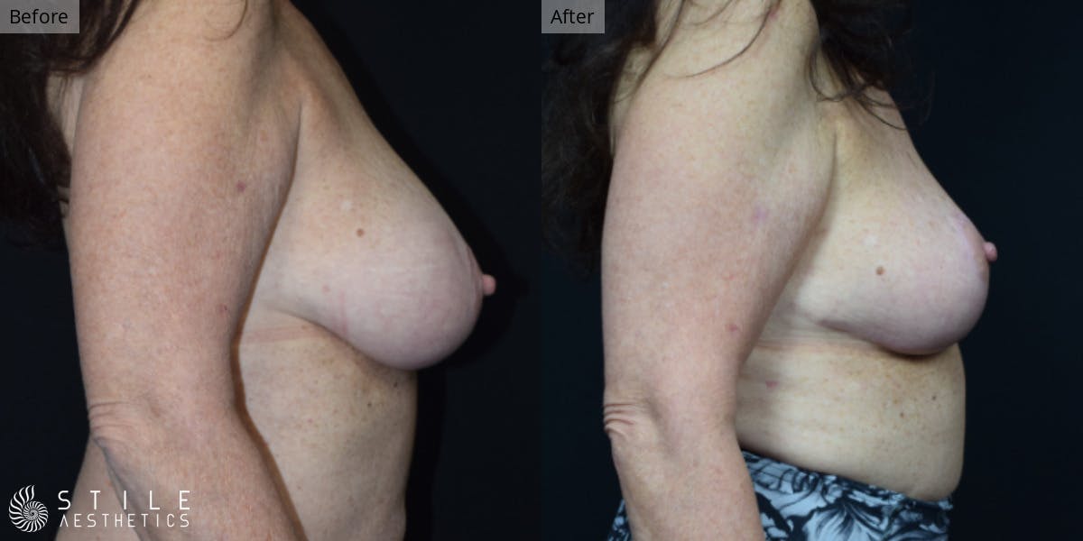 Breast Reduction Before & After Gallery - Patient 424994 - Image 2