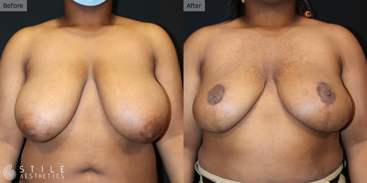 Breast Reduction Before & After Gallery - Patient 427949 - Image 1