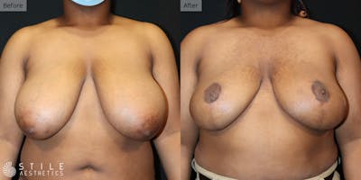 Breast Reduction Before & After Gallery - Patient 427949 - Image 1