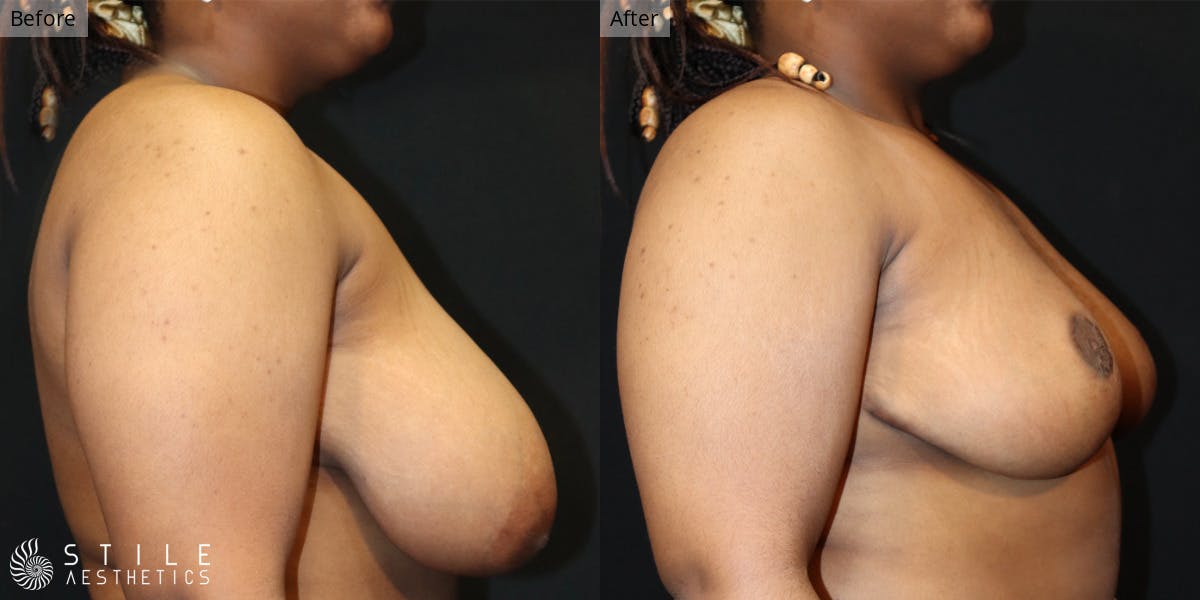 Breast Reduction Before & After Gallery - Patient 427949 - Image 2