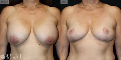 Breast Revision Surgery Before & After Gallery - Patient 154768 - Image 1