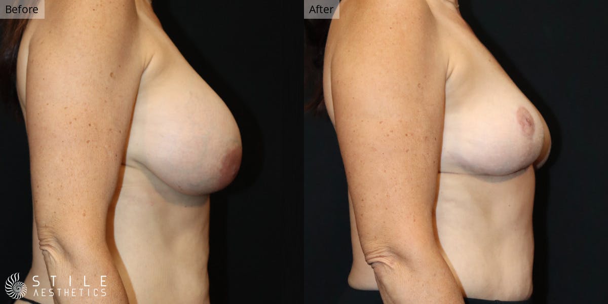 Breast Revision Surgery Before & After Gallery - Patient 154768 - Image 2