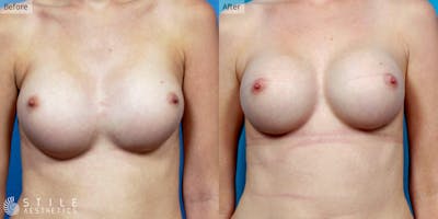 Breast Revision Surgery Before & After Gallery - Patient 252173 - Image 1