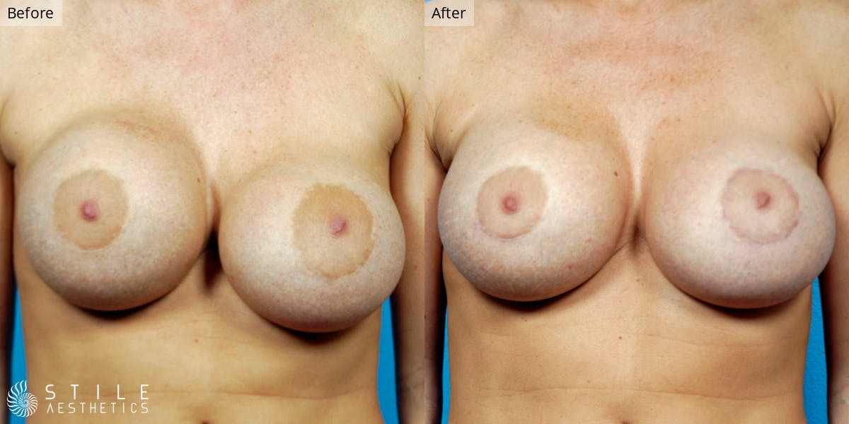 Breast Revision Surgery Before & After Gallery - Patient 821990 - Image 1