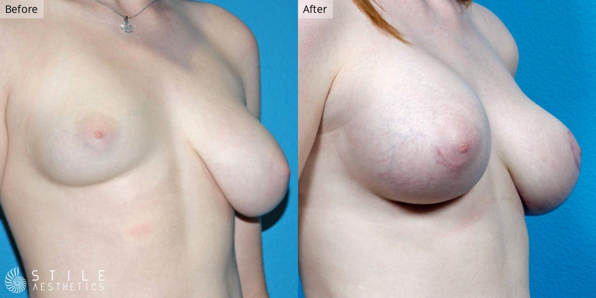 Breast Revision Surgery Before & After Gallery - Patient 322724 - Image 1