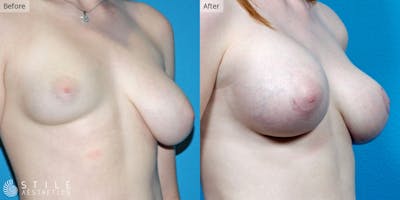 Breast Revision Surgery Before & After Gallery - Patient 322724 - Image 1