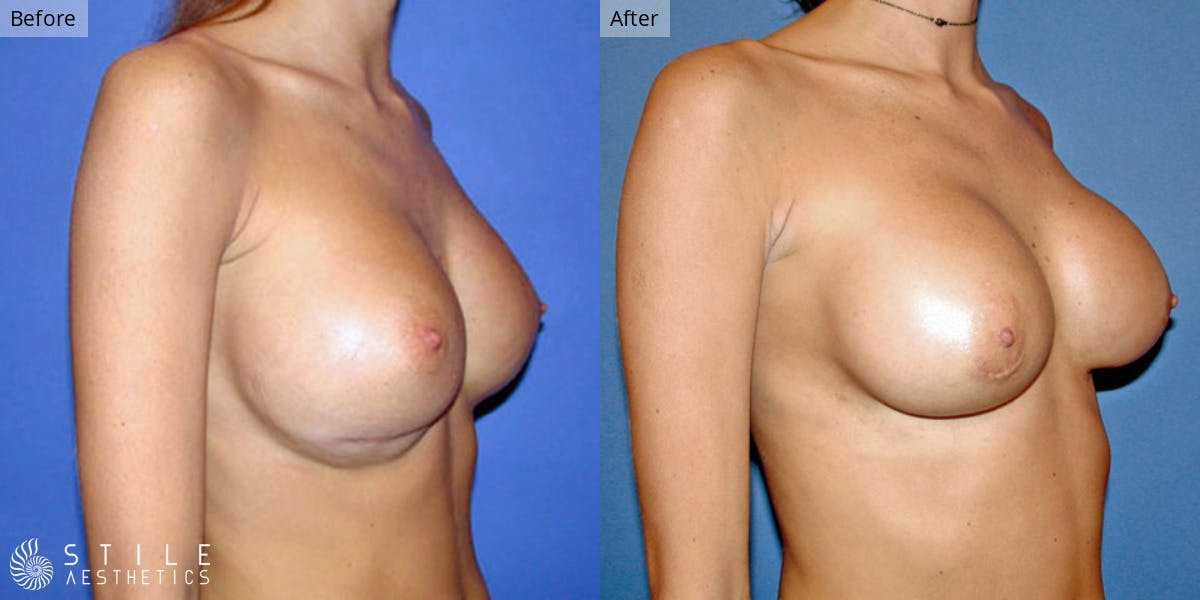 Breast Revision Surgery Before & After Gallery - Patient 408284 - Image 1
