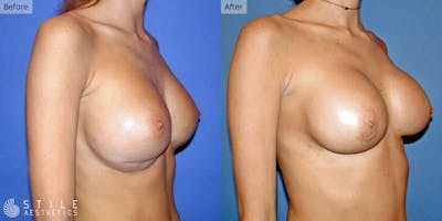 Breast Revision Surgery Before & After Gallery - Patient 408284 - Image 1