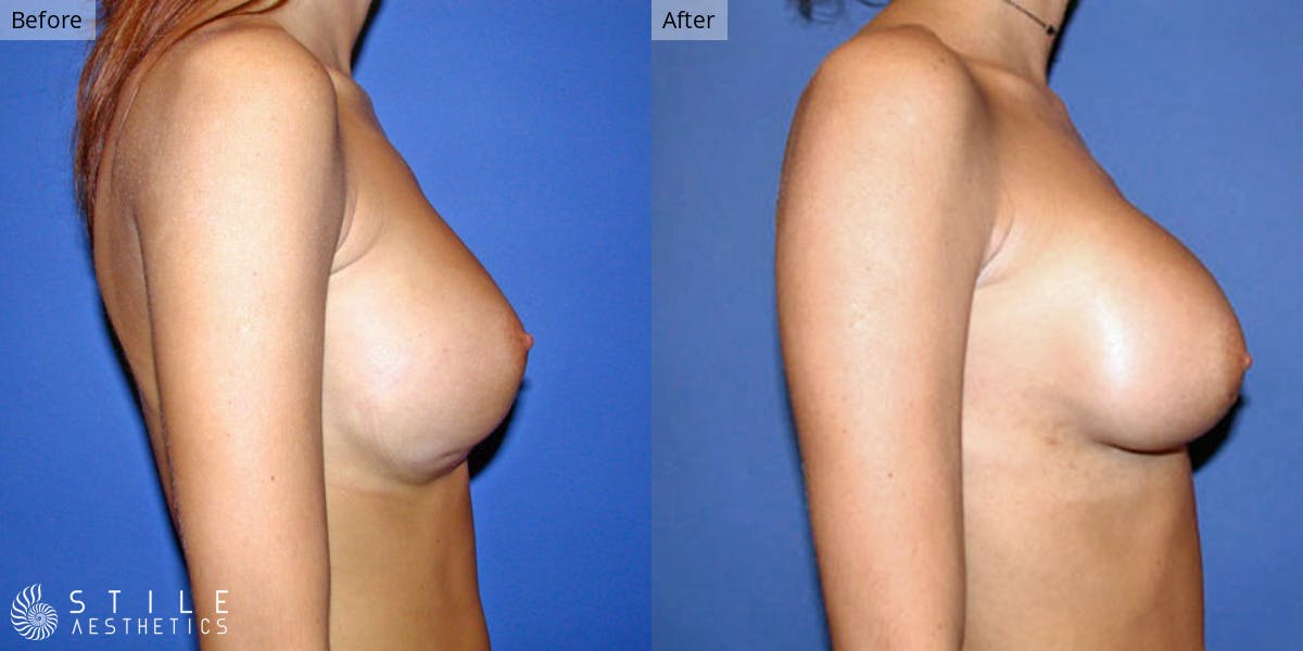 Breast Revision Surgery Before & After Gallery - Patient 408284 - Image 2