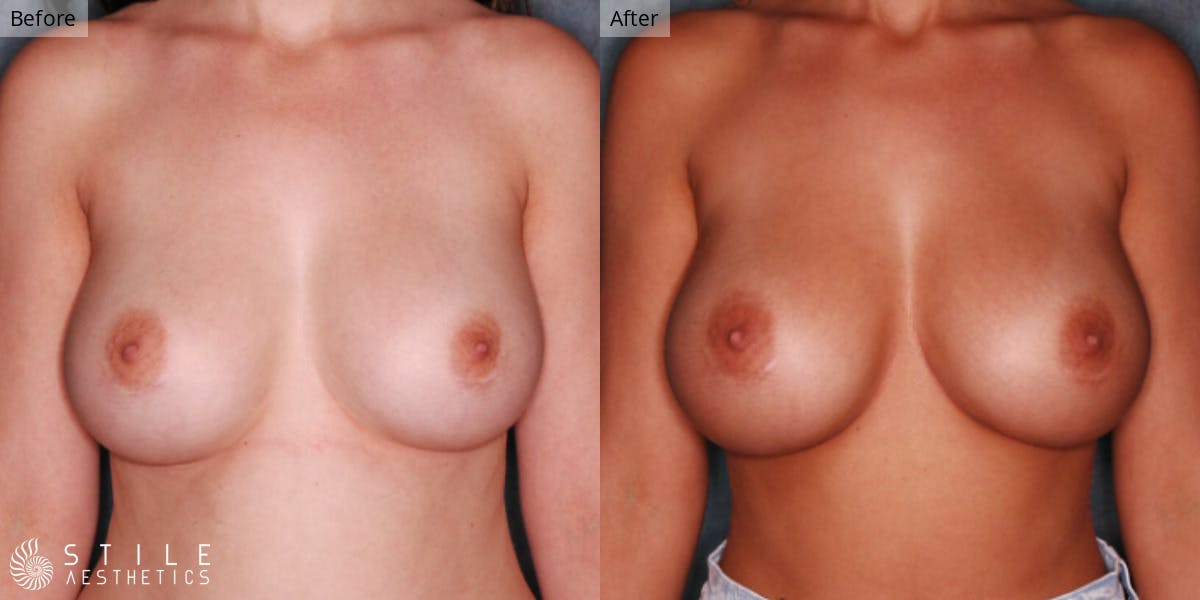 Breast Revision Surgery Before & After Gallery - Patient 120893 - Image 1