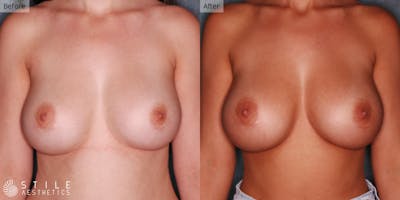 Breast Revision Surgery Before & After Gallery - Patient 120893 - Image 1