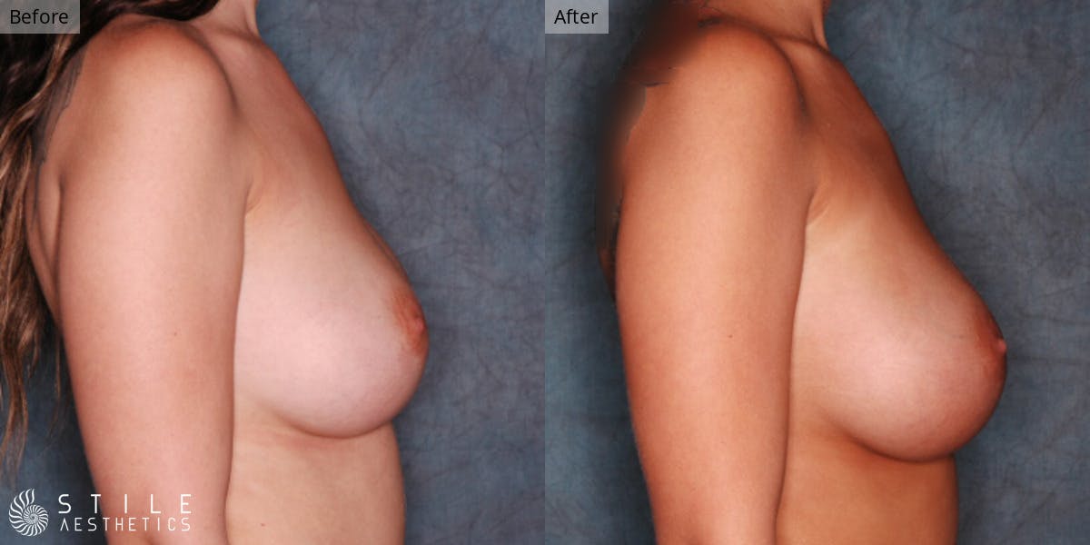 Breast Revision Surgery Before & After Gallery - Patient 120893 - Image 2