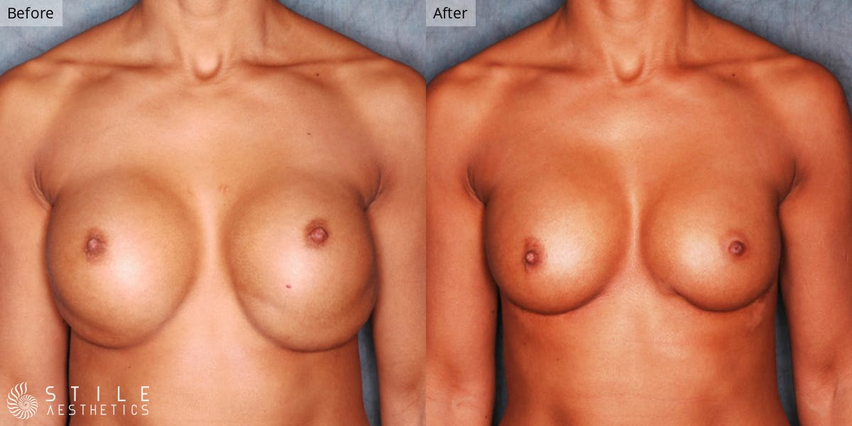 Breast Revision Surgery Before & After Gallery - Patient 926239 - Image 1