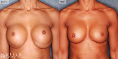 Breast Revision Surgery Before & After Gallery - Patient 926239 - Image 1